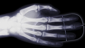 x ray hand